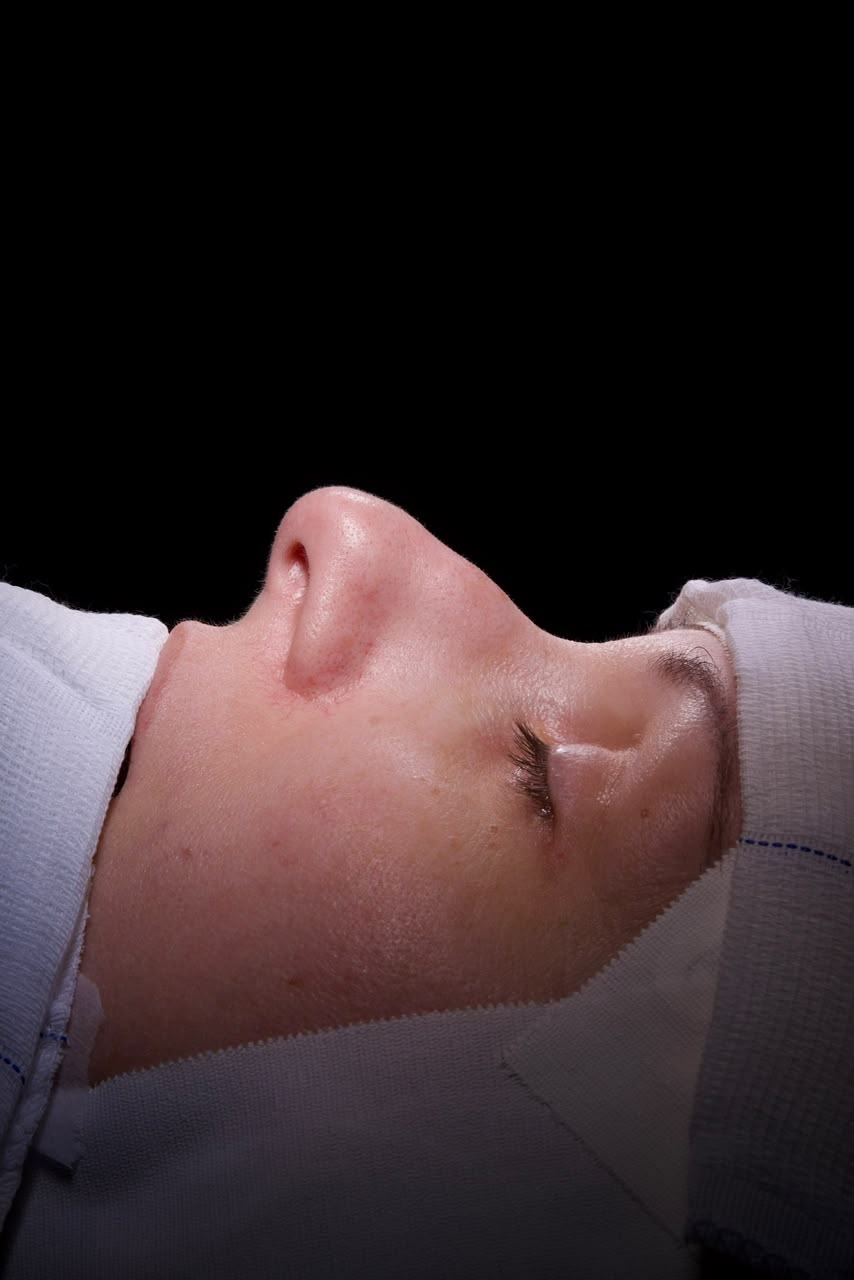 Rinoplastia antes do procedimento - paciente 1