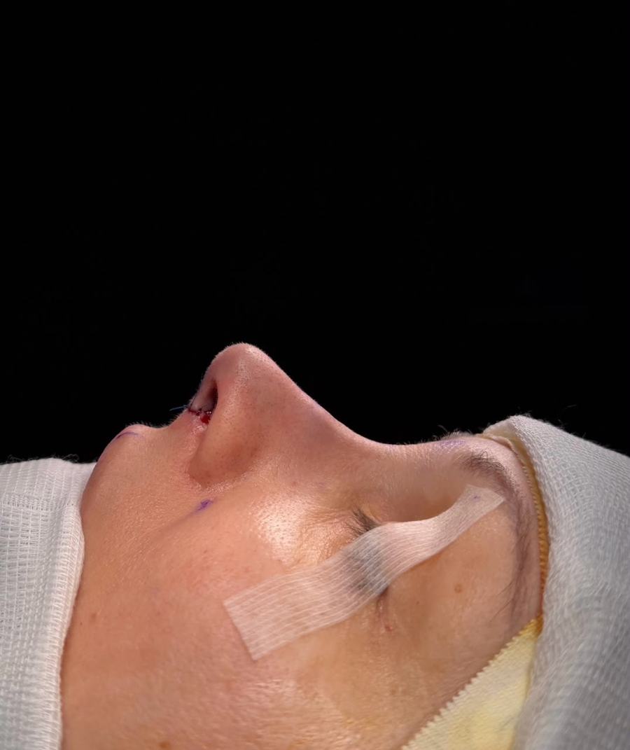 Rinoplastia depois do procedimento - paciente 1