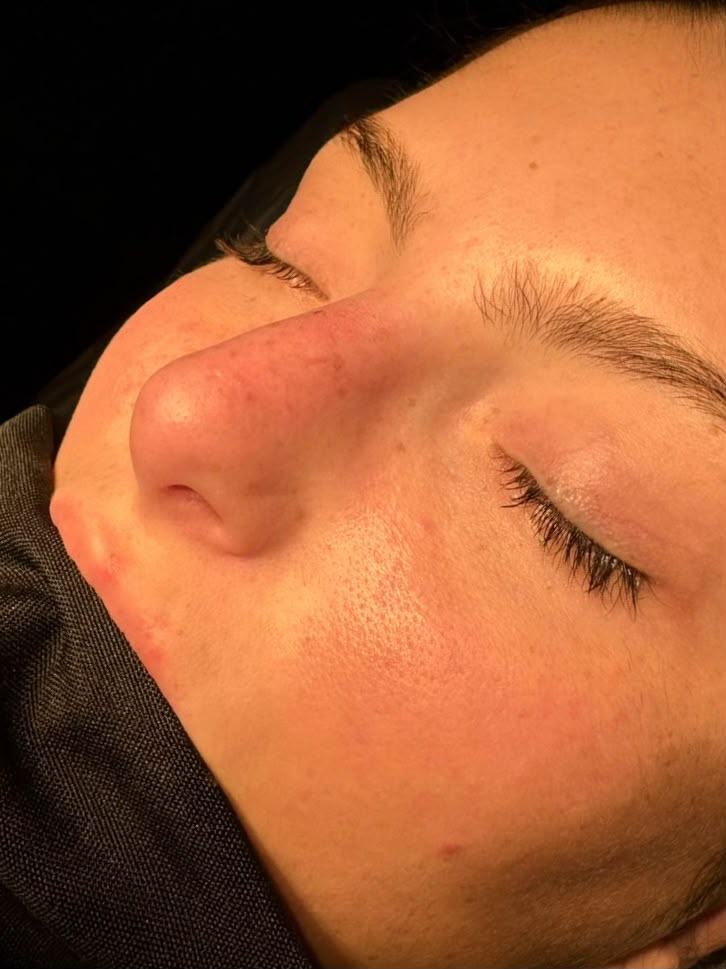 Rinoplastia antes do procedimento - paciente 2