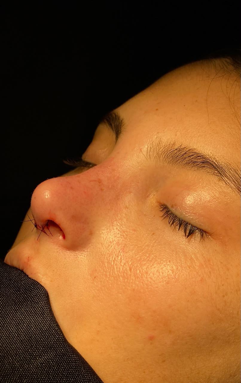 Rinoplastia depois do procedimento - paciente 2
