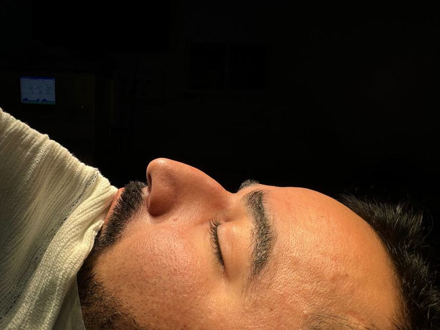 Rinoplastia antes do procedimento - paciente 3