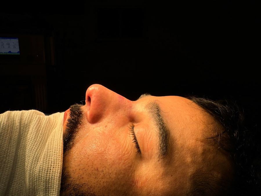 Rinoplastia depois do procedimento - paciente 3