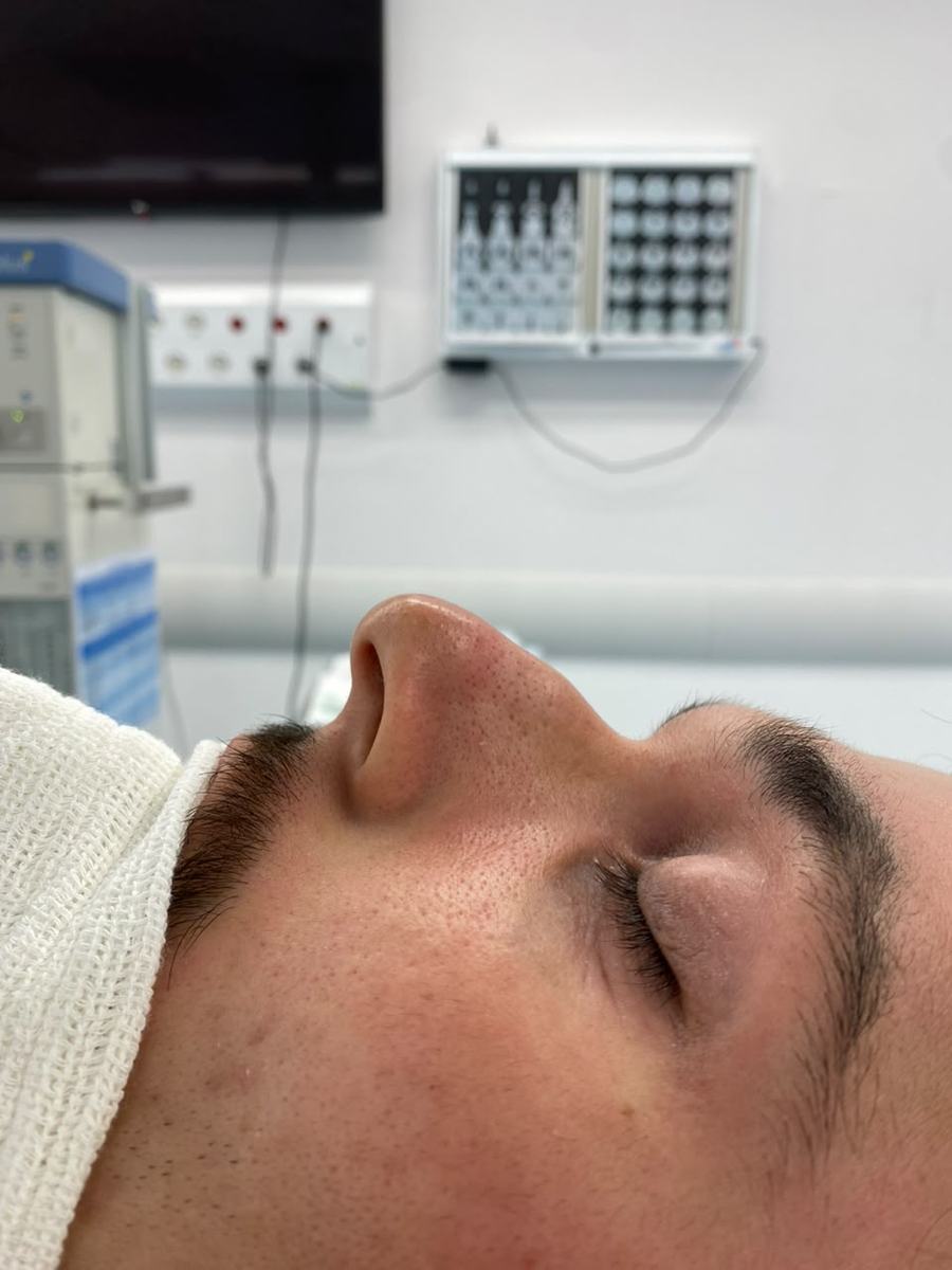 Rinoplastia antes do procedimento - paciente 4