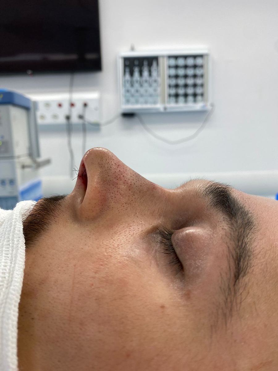 Rinoplastia depois do procedimento - paciente 4