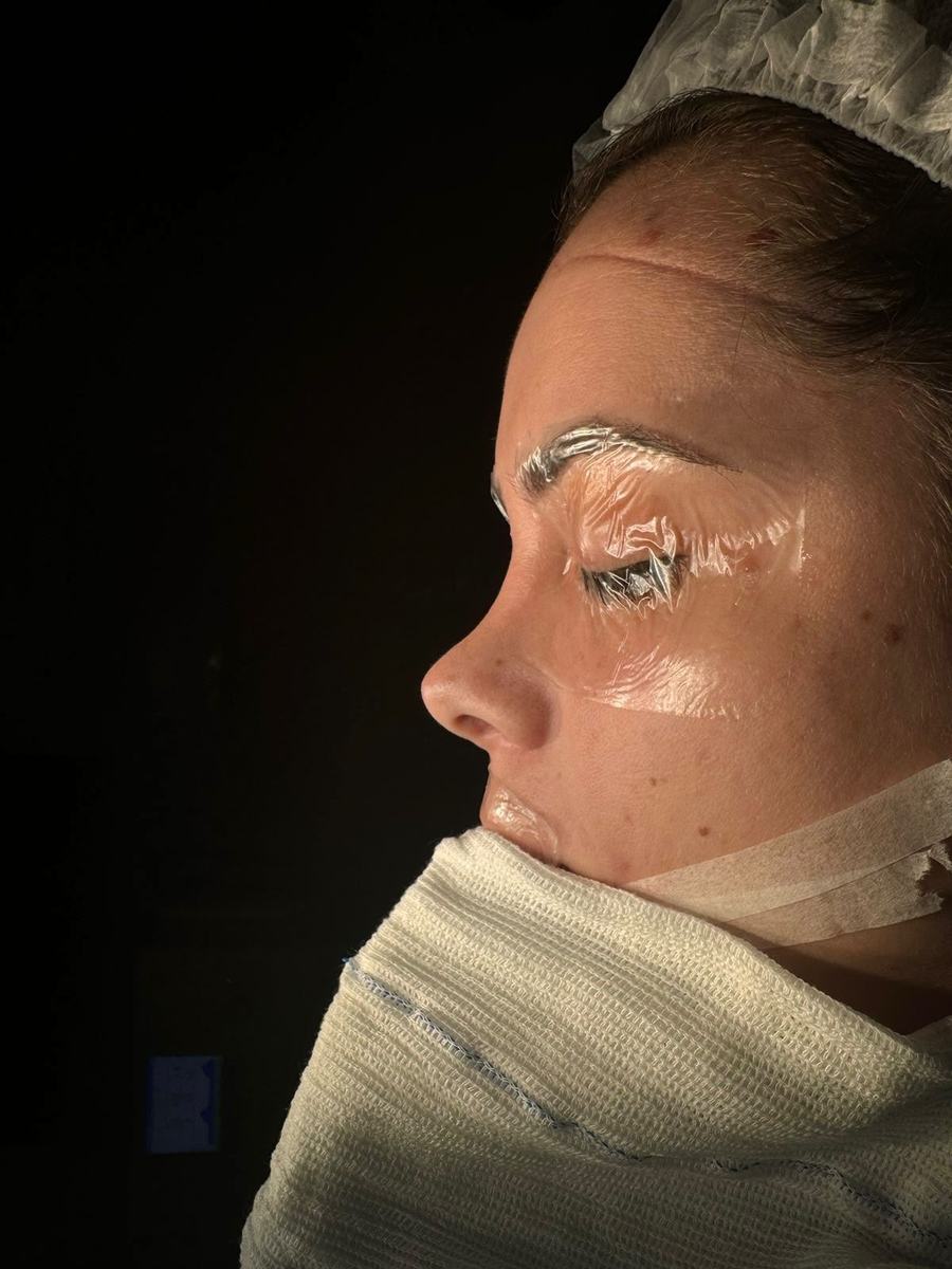 Rinoplastia antes do procedimento - paciente 5