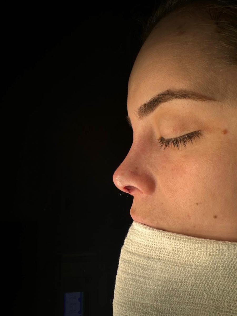 Rinoplastia depois do procedimento - paciente 5